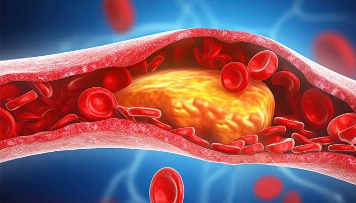 Maximum people unaware of their genetic risk for high cholesterol, study