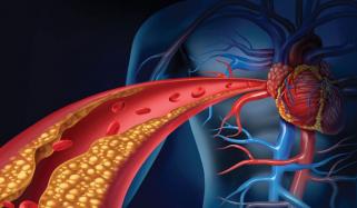 زیادہ تر مریض جینیاتی کولیسٹرول کے خطرات سے ناواقف