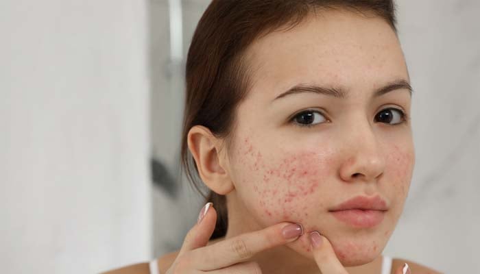 Tips to combat dryness, irritation, and acne-prone skin
