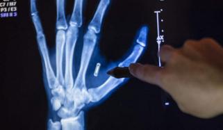 سائبورگ بننے کی کوشش کرنے والا ہاتھ میں لگی چپ کا پاس ورڈ بھول گیا