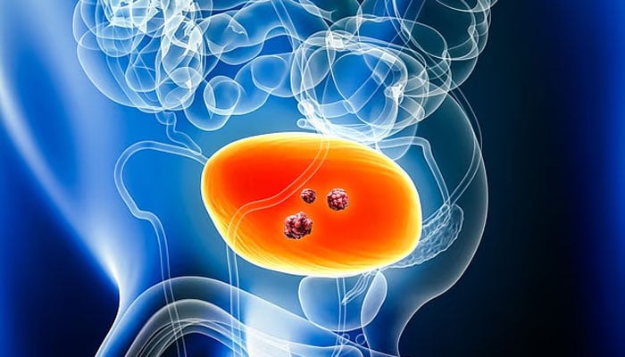 بچپن کی عام بیماری مثانہ کے کینسر کا باعث بن سکتی ہے، برطانوی محققین کا انکشاف
