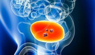 بچپن کی عام بیماری مثانہ کے کینسر کا باعث بن سکتی ہے، برطانوی محققین کا انکشاف