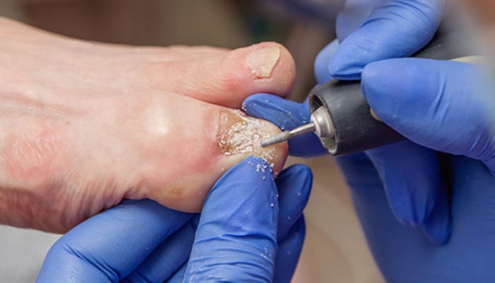 ناخنوں کے انفیکشن کے علاج میں نئی پیشرفت سامنے آگئی