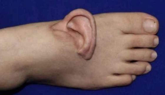 چینی سرجنز نے حادثے کے بعد خاتون کا کٹا ہوا کان اسکے پاؤں سے کیوں جوڑ دیا؟