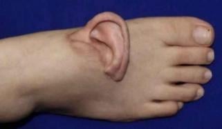 چینی سرجنز نے حادثے کے بعد خاتون کا کٹا ہوا کان اسکے پاؤں سے کیوں جوڑ دیا؟