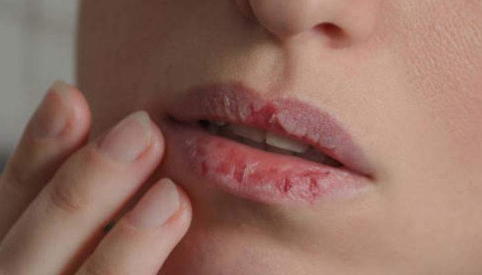 سردیوں میں ہونٹ کیوں خشک ہوتے ہیں؟