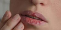 سردیوں میں ہونٹ کیوں خشک ہوتے ہیں؟