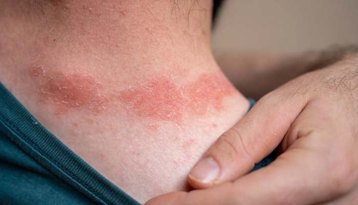 Iron deficiency common in moderate-to-severe Atopic Dermatitis, study finds