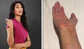 کنسرٹ کے دوران شائے گل حادثے کا شکار، ڈرون لگنے سے زخمی