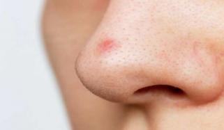 اسکین کینسر کی علامت جسے پمپل سمجھ کر نظر انداز کر دیا جاتا ہے