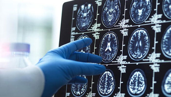 سر کا سائز زندگی کے آخری حصے میں ڈیمنشیا کی تشخیص کی نشاندہی کر سکتا ہے، سائنسدان