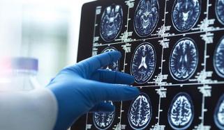 سر کا سائز زندگی کے آخری حصے میں ڈیمنشیا کی تشخیص کی نشاندہی کر سکتا ہے، سائنسدان 