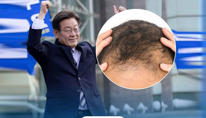 جنوبی کوریا کے صدر نے گنج پن کو سنگین مسئلہ قرار دے دیا