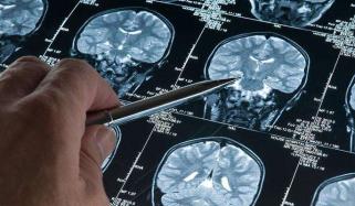 الزائمر کے 90 فیصد سے زائد کیسز ایک ہی جین سے منسلک ہوتے ہیں، سائنسی تحقیق