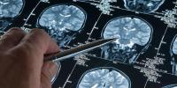 الزائمر سے متعلق نئی تحقیق سامنے آگئی