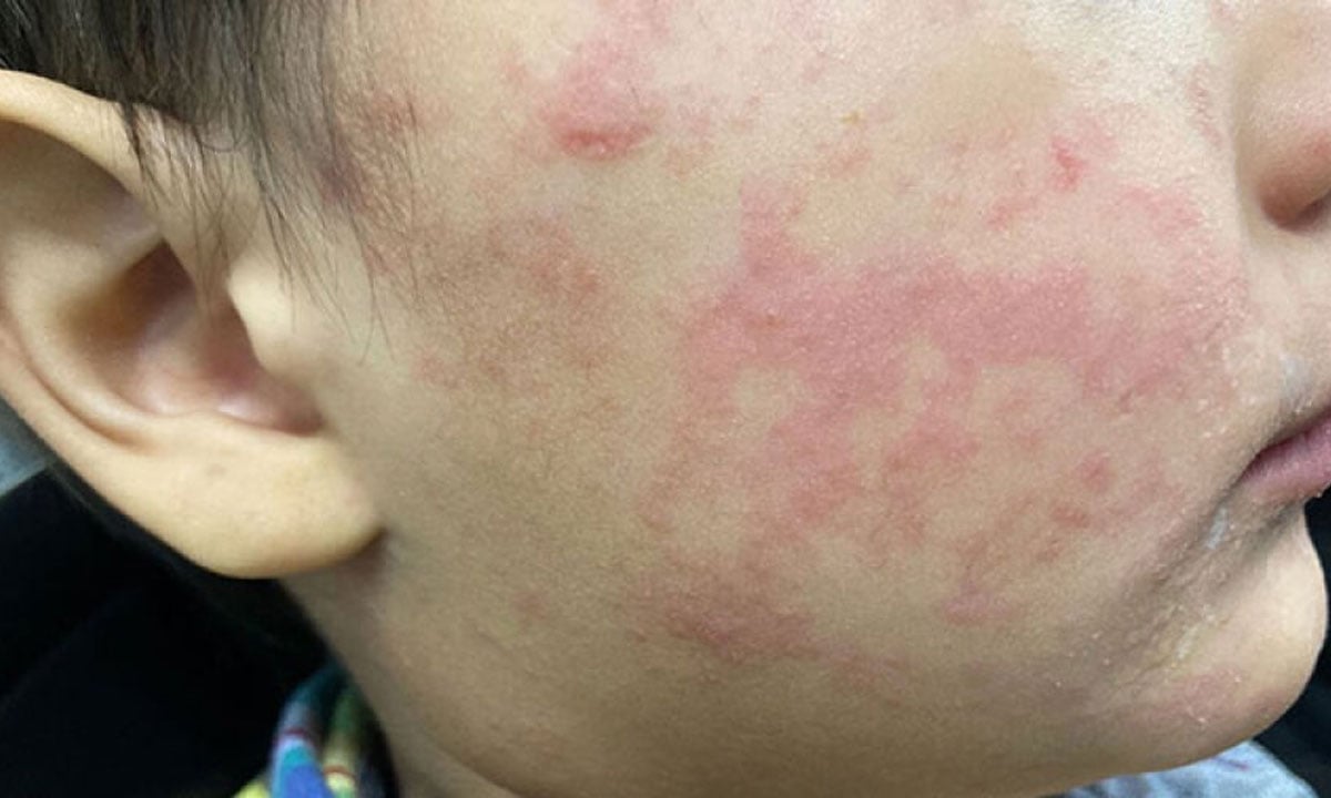 Measles outbreak in South Carolina exceeds 300 cases, spreads to other states