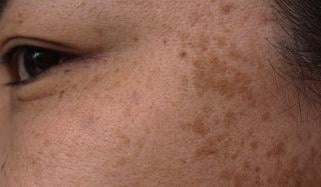 جلد کے سیاہ دھبے کیا بتاتے ہیں؟ ماہرِ غذائیت نے ہائپرپگمنٹیشن کی اصل وجوہات بتا دیں