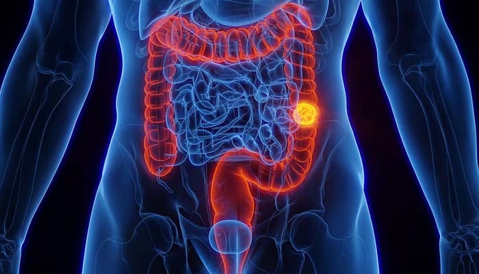Colon cancer becomes leading cause of deaths in Americans under 50