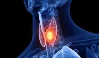 تھائیرائیڈ کینسر کے خطرے کو بڑھانے والے 7 اہم عوامل