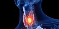 تھائیرائیڈ کینسر کے خطرے کو بڑھانے والے 7 اہم عوامل