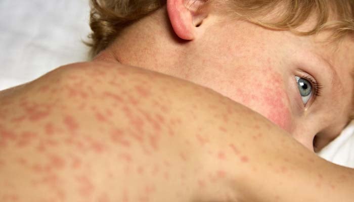 Arizona officials respond after measles diagnosed at ICE detention facility