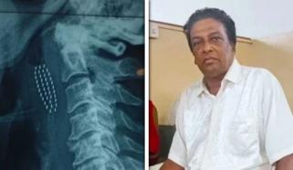 سری لنکا: دانت صاف کرتے ہوئے 1 شخص کی زندگی داؤ پر لگ گئی