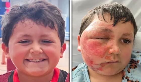 9 سالہ بچے کو خطرناک سوشل میڈیا ٹرینڈ مہنگا پڑگیا