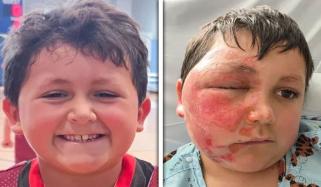  9 سالہ بچے کو خطرناک سوشل میڈیا ٹرینڈ مہنگا پڑگیا