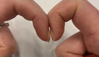 انگلیوں کا یہ ٹیسٹ پھیپھڑوں کے کینسر کی تشخیص کر سکتا ہے: ماہرین