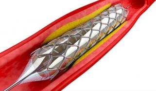 اسٹنٹ لگوانے کے بعد کن باتوں سے پرہیز ضروری؟ ماہرِ امراضٍ قلب کی اہم ہدایات