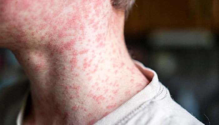 Officials issue health alert in UK due to rapidly increasing Measles cases in schools