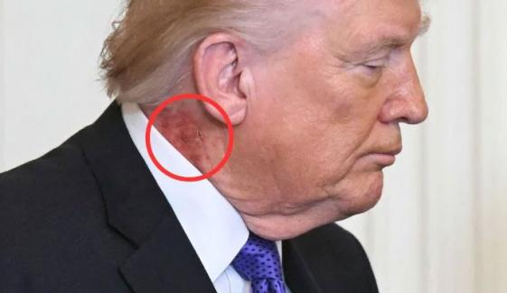 ٹرمپ کی گردن پر سرخ نشان، صحت سے متعلق نئی بحث چھڑ گئی