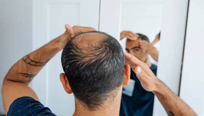 سائنسدانوں کی گنج پن کے علاج میں بڑی کامیابی، لیبارٹری میں پہلی بار مکمل فعال بال تیار