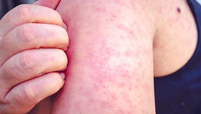 Health officials confirm 6 new cases in local jail in New Mexico