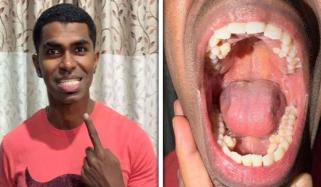 ملائیشین شخص کے منہ میں 42 دانت، گنیز ورلڈ ریکارڈ قائم