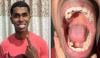 ملائیشین شخص کے منہ میں 42 دانت، گنیز ورلڈ ریکارڈ قائم