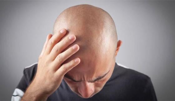 مردوں میں گنج پن کی بڑی وجہ سامنے آ گئی