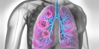 شدید کورونا اور فلو کے بعد پھیپھڑوں کے کینسر کا خطرہ بڑھ سکتا ہے، نئی تحقیق