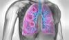 شدید کورونا اور فلو کے بعد پھیپھڑوں کے کینسر کا خطرہ بڑھ سکتا ہے، نئی تحقیق