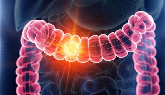  50 سال سے کم عمر افراد میں کینسر سے اموات کی بڑی وجہ سامنے آگئی