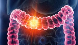 آنتوں کا کینسر 50 سال سے کم عمر افراد میں کینسر سے اموات کی بڑی وجہ
