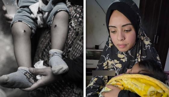 فلسطینی شخص کے سامنے اسکے 18 ماہ کے بچے کا جسم سگریٹ سے داغدار