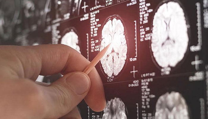 برین ٹیومر کی 7 ایسی علامات جن کے بارے میں جاننا ضروری ہے، محقق