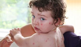 کراچی: بچوں میں خسرہ، چکن پاکس اور ممپس کے کیسز بڑھنے لگے