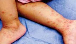 رواں سال ملک بھر میں خسرہ سے 71 اموات رپورٹ