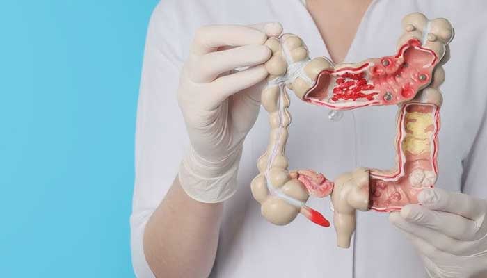 New blood test offers alternative for colon cancer screening