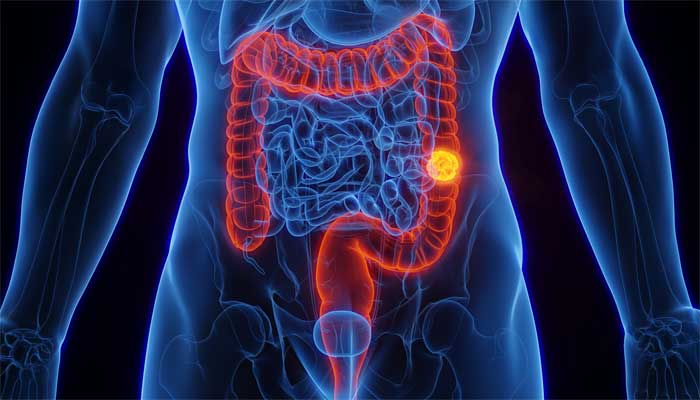 New blood test offers alternative for colon cancer screening