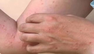 کراچی میں رواں سال منکی پاکس کا 10 واں کیس رپورٹ
