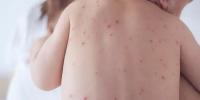 رواں سال سندھ میں خسرہ سے 53 اموات رپورٹ، ذرائع محکمہ صحت