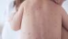 رواں سال سندھ میں خسرہ سے 53 اموات رپورٹ، ذرائع محکمہ صحت